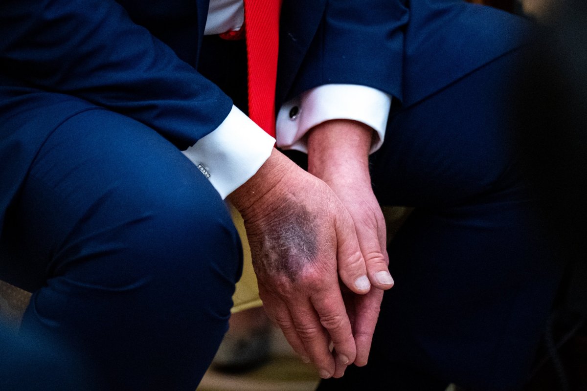 <p>El mandatario suele disimular con maquillaje los moretones en sus manos y decoloración en su cuello. (Foto: Bloomberg)</p>